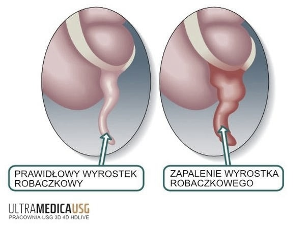 Ile zwolnienia po wycięciu wyrostka robaczkowego? Od czego zależy powrót do pracy